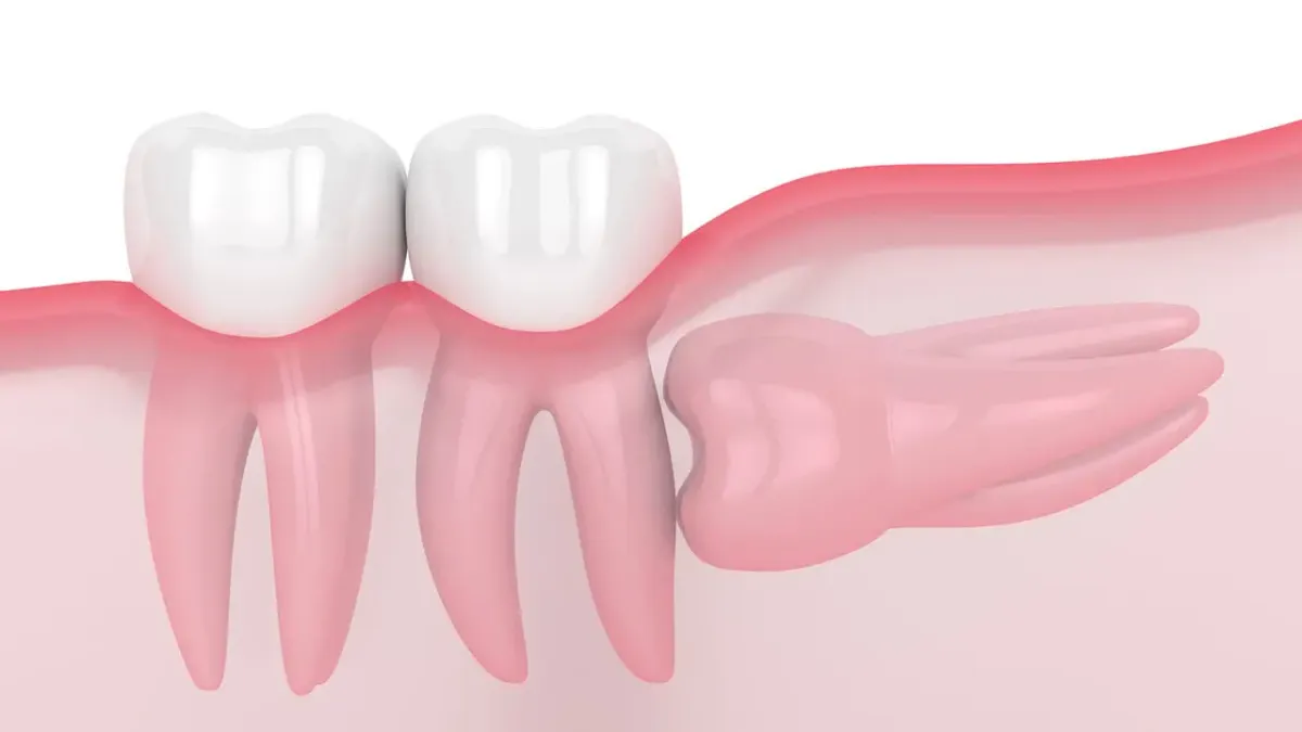 Disappearing Teeth