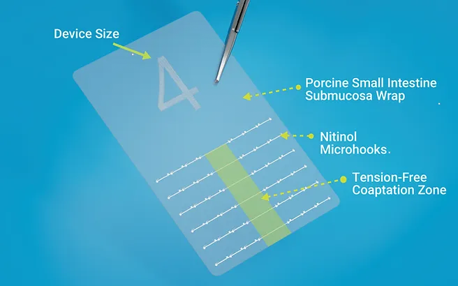 Nerve Tape®: The FDA-Approved Medical Device Revolutionizing Nerve Repair